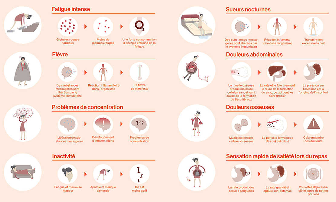 Infographic - Symptômes de la polycythémie vraie