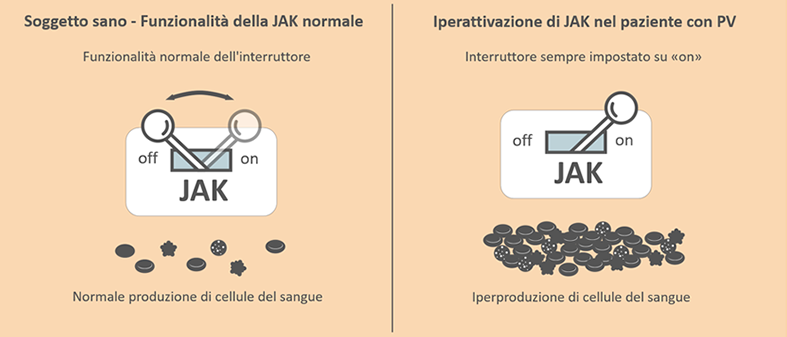 In un paziente affetto da PV, la Janus chinasi (JAK) è sempre «on», con conseguente iperproduzione di cellule del sangue. 