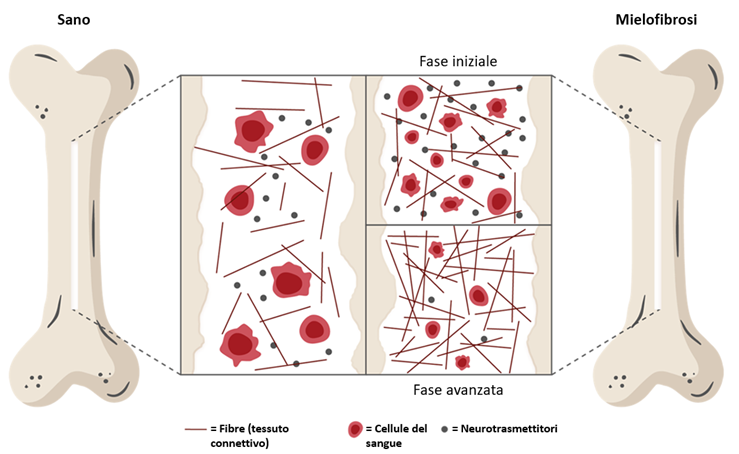 In che modo il midollo osseo diventa fibroso?