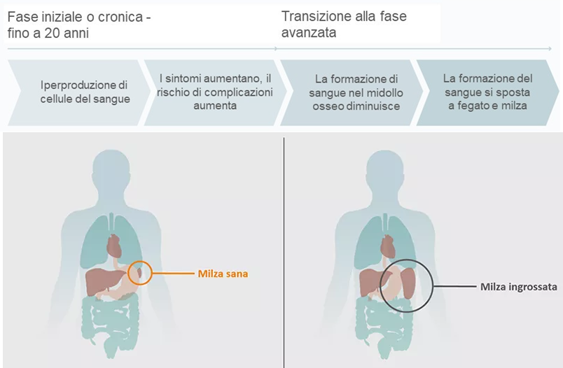 Qual è il decorso della policitemia vera? Qual è il decorso della policitemia vera?