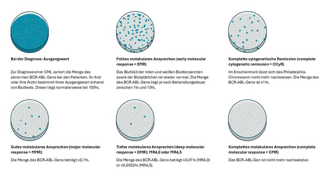 Infographic - CML Zwischenziele der Behandlung