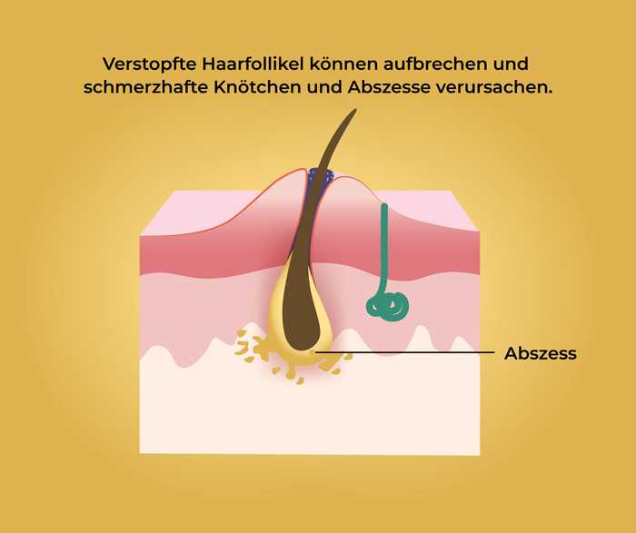 Akne inversa: Abszess- und Fistelbildung (2) Schematische Darstellung eines Abszesses in der Haut und der Aufschrift «Verstopfte Haarfollikel können aufbrechen und schmerzhafte Knötchen und Abszesse verursachen .»
