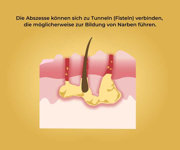 Akne inversa: Abszess- und Fistelbildung (3) Schematische Darstellung von Fisteln in der Haut und der Aufschrift «Die Abszesse können sich zu Tunneln (Fisteln) verbinden, die möglicherweise zur Bildung von Narben führen .»