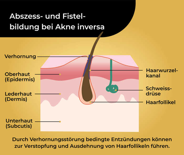 Akne inversa: Abszess- und Fistelbildung (1) Schematische Darstellung eines Haars in der Haut mit Beschriftung von Oberhaut (Epidermis), Lederhaut (Dermis), Unterhaut (Subcutis), verhorntem Haarwurzelkanal, Schweissdrüse und Haarfollikel. Unten steht «Durch Verhornungsstörung bedingte Entzündungen können zur Verstopfung und Ausdehnung von Haarfollikeln führen .»