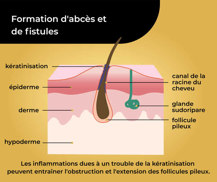 Maladie de Verneuil: Formation d′abcès et de fistules (1) Représentation schématique d′un poil dans la peau avec la légende de l′épiderme, du derme, de l′hypoderme, du canal kératinisé de la racine du cheveu, de la glande sudoripare et du follicule pileux. On peut lire ci-dessous «Les inflammations dues à un trouble de la kératinisation peuvent entraîner l′obstruction et l′extension des follicules pileux.»