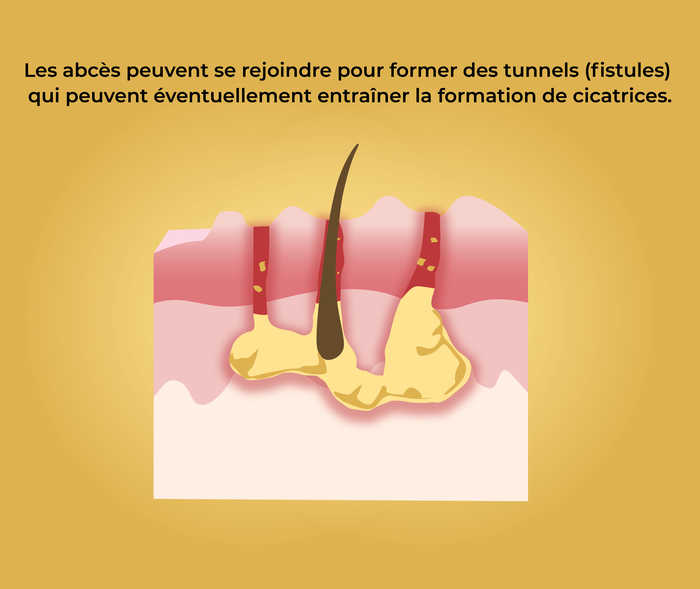 Maladie de Verneuil: Formation d′abcès et de fistules (3) Représentation schématique de fistules dans la peau avec la légende «Les abcès peuvent se rejoindre pour former des tunnels (fistules) qui peuvent éventuellement entraîner la formation de cicatrices.»