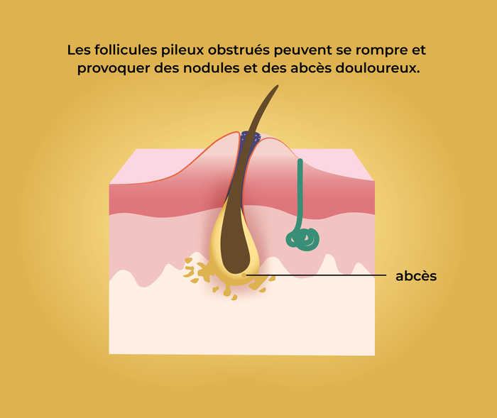 Maladie de Verneuil: Formation d′abcès et de fistules (2) Représentation schématique d′un abcès dans la peau avec la légende «Les follicules pileux obstrués peuvent se rompre et provoquer des nodules et des abcès douloureux.»