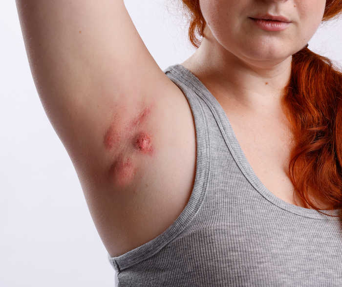 La personne montre son aisselle, qui est rouge.