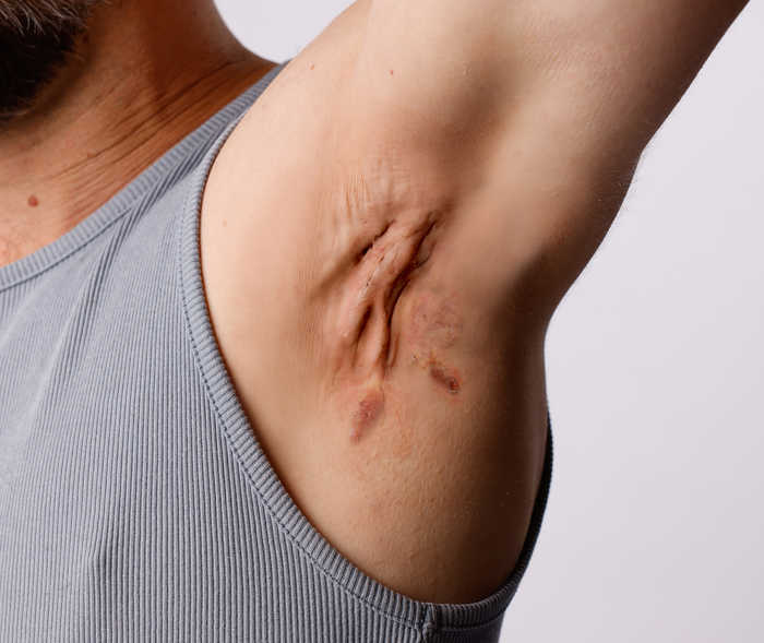 La personne montre son aisselle rougie avec des inflammations et des cicatrices.