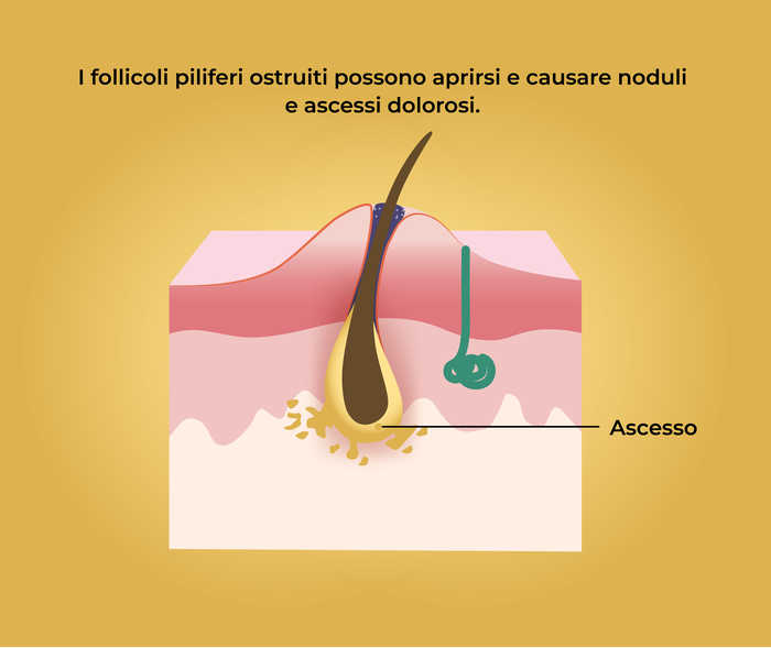 Acne inversa: formazione di ascessi e fistole Rappresentazione schematica di un ascesso cutaneo e la scritta «I follicoli piliferi ostruiti possono aprirsi e causare noduli e ascessi dolorosi