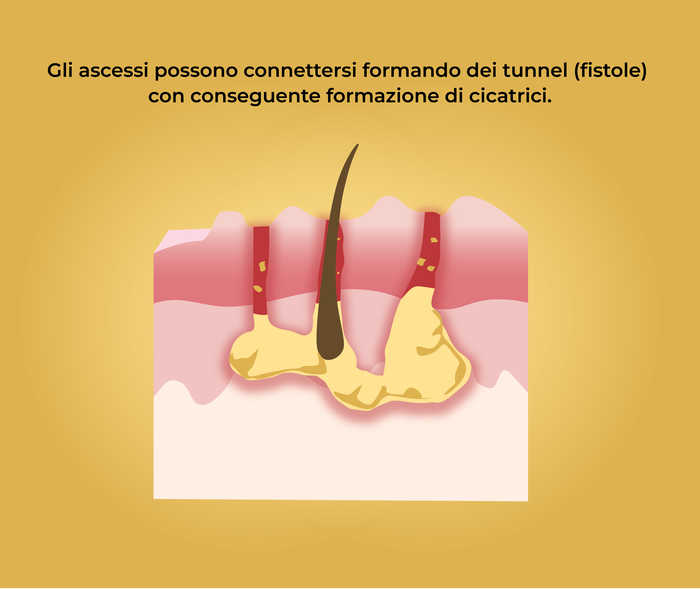 Acne inversa: formazione di ascessi e fistole Rappresentazione schematica di fistole nella pelle e la scritta «Gli ascessi possono connettersi formando dei tunnel (fistole) con conseguente formazione di cicatrici