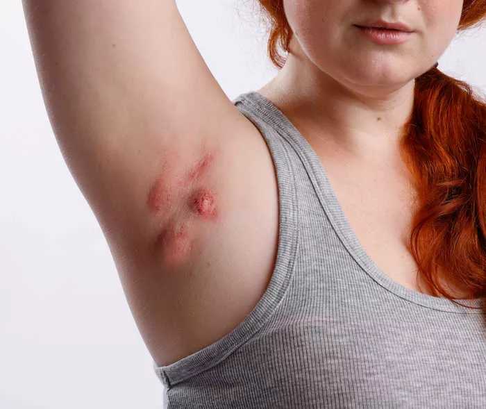 Una persona mostra l’ascella ​​con lesioni da acne inversa.