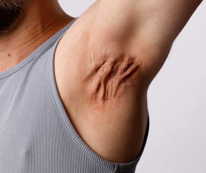 Una persona mostra l’ascella arrossata con infiammazione e cicatrici.