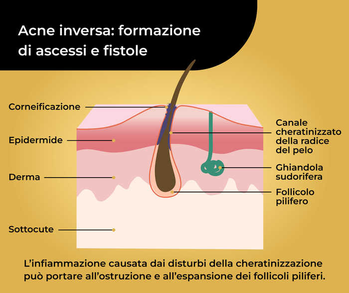 Acne inversa: formazione di ascessi e fistole Rappresentazione schematica di un pelo nella pelle, con l’indicazione dell’epidermide, del derma, del sottocute, del canale cheratinizzato della radice del pelo, della ghiandola sudorifera e del follicolo pilifero. Sotto c’è scritto «L’infiammazione causata dai disturbi della cheratinizzazione può portare all’ostruzione e all’espansione dei follicoli piliferi