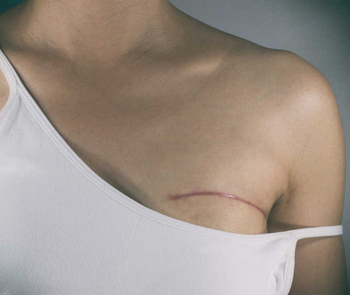 Oberkörper einer Frau mit einer Narbe über einer Brust.