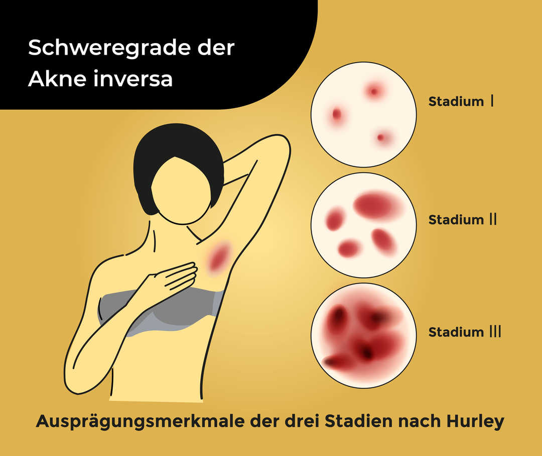 Schematisch dargestellter Mensch mit erhobenem Arm zeigt ihre gerötete Achsel. Oben steht «Schweregrade der Akne inversa» und unten «Ausprägungsmerkmale der drei Stadien nach Hurley». Die drei Stadien sind in Kreisen dargestellt: Stadium I mit kleinen vereinzelten Rötungen, Stadium II mit mehreren größeren Rötungen, Stadium III mit großflächigen starken Rötungen.