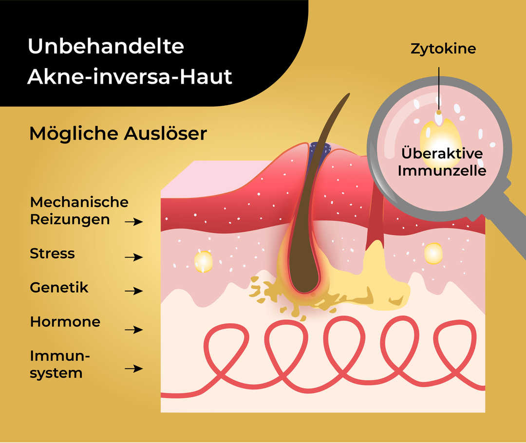 Schematische Darstellung von unbehandelter Akne-inversa-Haut mit einer überaktiven Immunzelle, Zytokinen und möglichen Auslösern, die als «Mechanische Reizungen, Stress, Genetik, Hormone, Immunsystem» beschriftet sind. Von den einzelnen Auslösern weisen fünf Pfeile in Richtung der Haut.