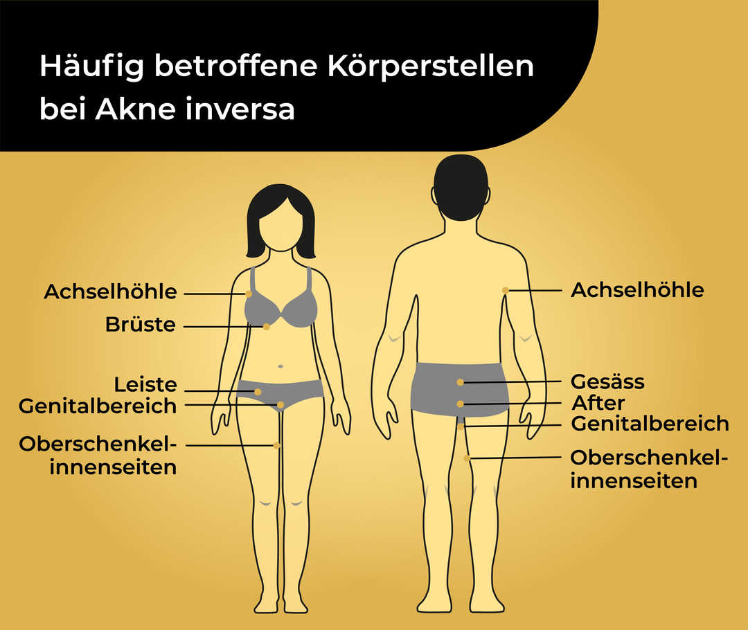 Schematische Darstellung von zwei menschlichen Körpern in Unterwäsche mit der Überschrift «Häufig betroffene Körperstellen bei Akne inversa». Die weibliche Figur trägt die Beschriftungen «Achselhöhle, Brüste, Leiste, Genitalbereich, Oberschenkelinnenseiten». Bei der männlichen Figur steht «Achselhöhle, Gesäss, After, Genitalbereich, Oberschenkelinnenseiten».