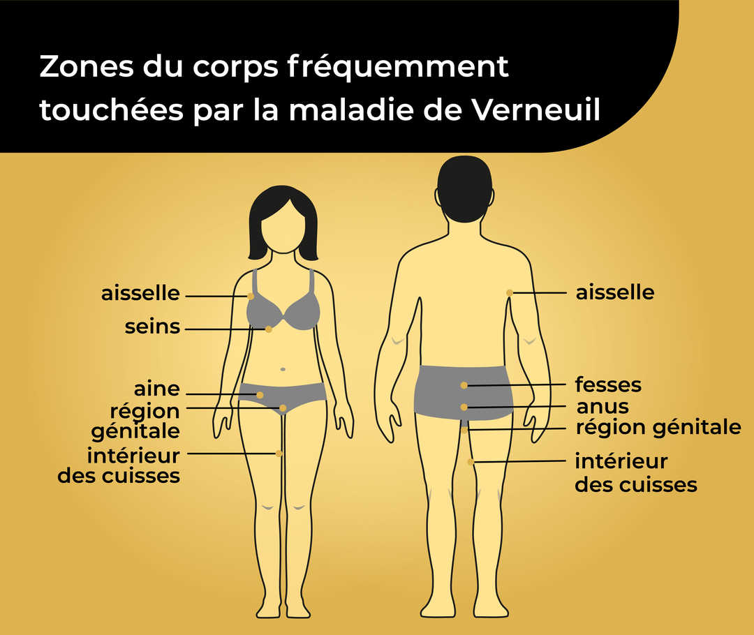 Représentation schématique de deux corps humains en sous-vêtements avec le titre «Zones du corps fréquemment touchées par la maladie de Verneuil». La figure féminine porte les inscriptions «aisselle, seins, aine, région génitale, intérieur des cuisses». Pour la figure masculine, il est écrit «aisselle, fesses, anus, région génitale, intérieur des cuisses».