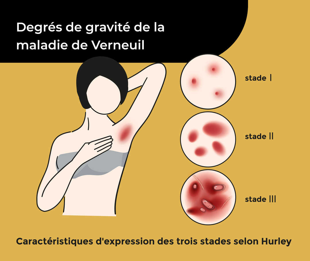 Représentation schématique d′une personne avec le bras levé montrant son aisselle rougie. En haut, il est écrit «Degrés de gravité de la maladie de Verneuil» et en bas «caractéristiques d′expression des trois stades selon Hurley». Les trois stades sont représentés par des cercles: Stade I avec de petites rougeurs isolées, stade II avec plusieurs rougeurs plus importantes, stade III avec des rougeurs importantes sur une grande surface.