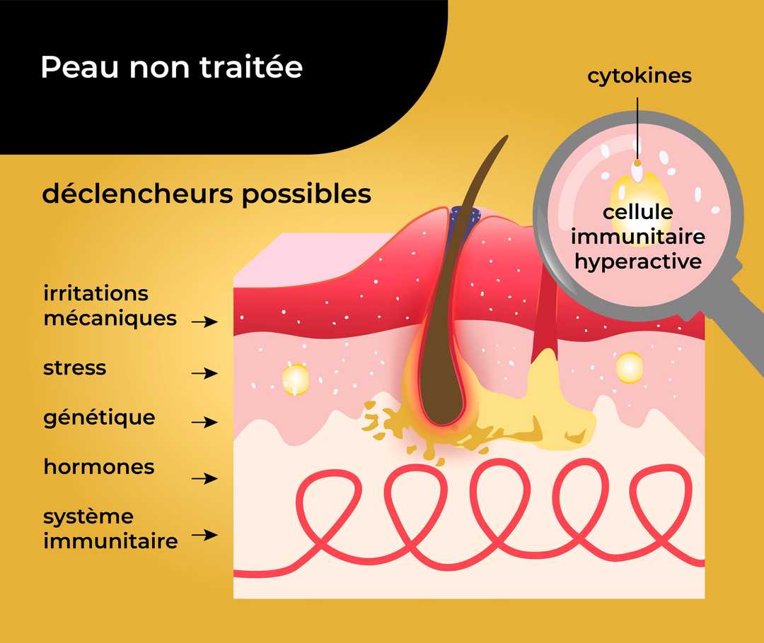 Représentation schématique d′une peau atteinte de la maladie de Verneuil non traitée avec une cellule immunitaire hyperactive, des cytokines et des déclencheurs possibles avec les inscriptions «irritations mécaniques, stress, génétique, hormones, système immunitaire». Parmi les différents déclencheurs, cinq flèches pointent en direction de la peau.