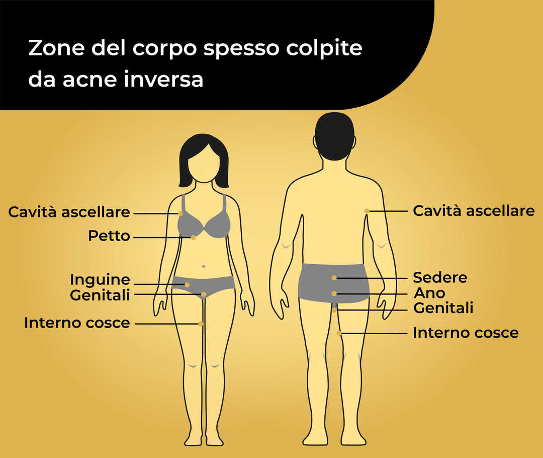 Rappresentazione schematica di due corpi umani, uno femminile e uno maschile, in biancheria intima con la didascalia «Parti del corpo frequentemente colpite dall’acne inversa». La figura femminile reca le didascalie «Ascella, seno, inguine, area genitale, interno cosce». La figura maschile reca la didascalia «Ascella, natiche, ano, area genitale, interno cosce