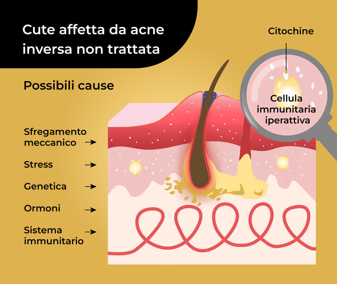 Acne inversa: pelle affetta da acne inversa non trattata 
