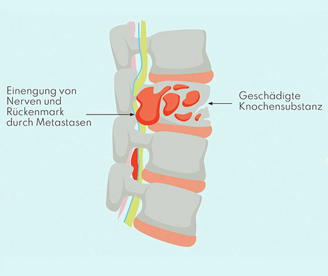 Schmerzen durch Knochenmetastasen Schematische Darstellung von Knochenmetastasen in der Wirbelsäule.