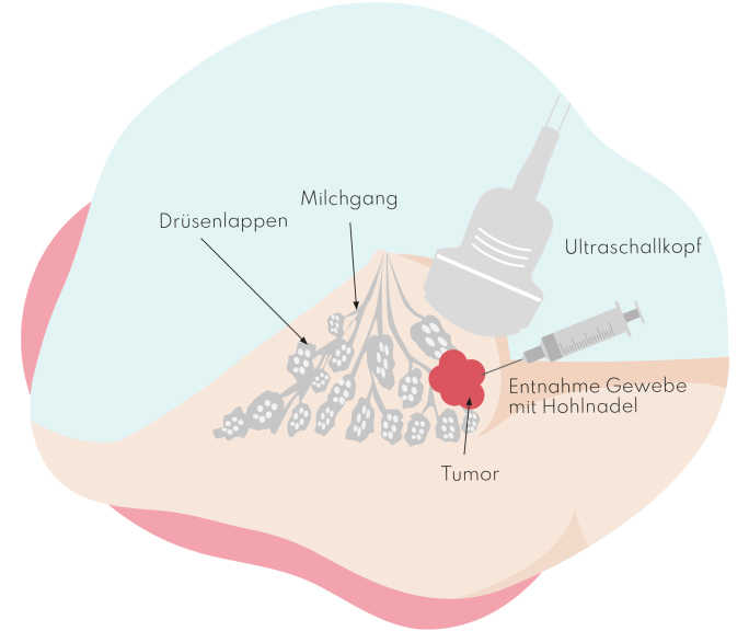 Zeichnung einer Brust mit Gewebeentnahme des Tumors über eine Nadel. Auf der Brust liegt ein Ultraschallkopf.
