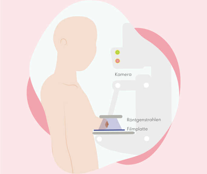 Schematische Darstellung einer Mammografie.