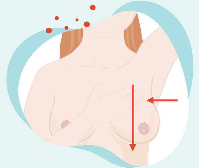 Illustration du torse nu d’une femme. À côté d’un sein, on voit une flèche de côté et une autre verticale du haut vers le bas.