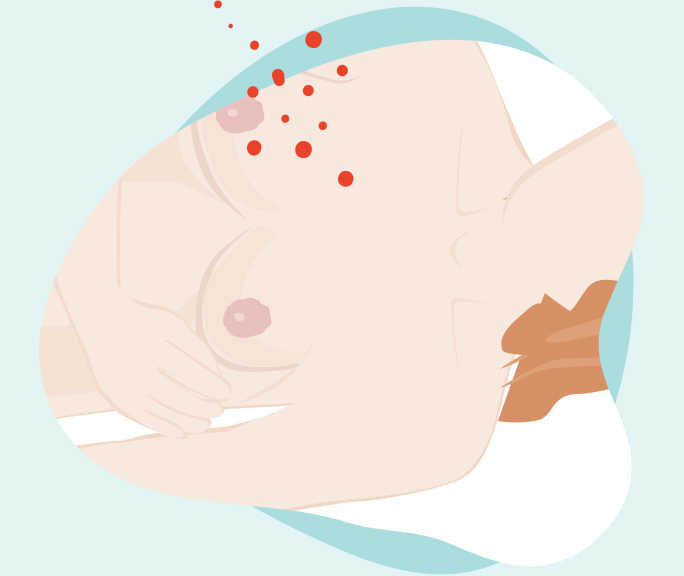 Illustration du torse nu d’une femme en position couchée. Une main est sous le sein.