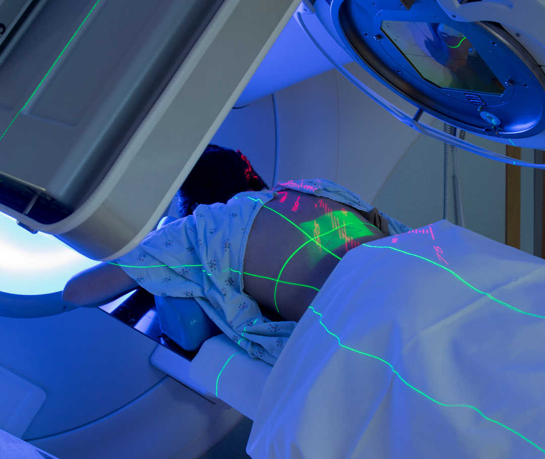 Une personne est allongée dans un appareil de radiothérapie. Le dos est traité par irradiation. 