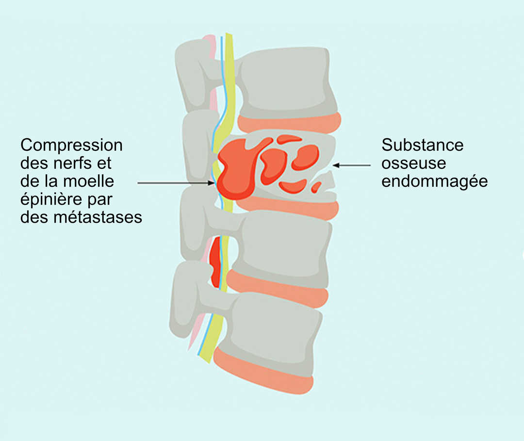 Compression des nerfs et de la moelle épinière par des métastases