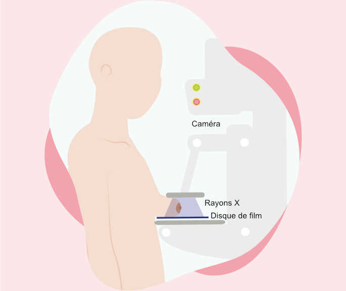  mammographie